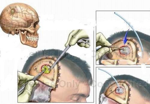 Mổ dẫn lưu áp xe não có nguy hiểm không?