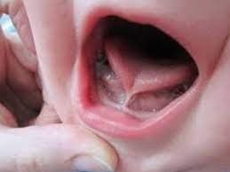 Treatment of cutting tongue brake for baby