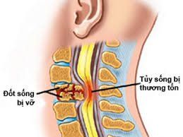 Loss of feeling of need to defecate after cervical spinal cord injury should do?