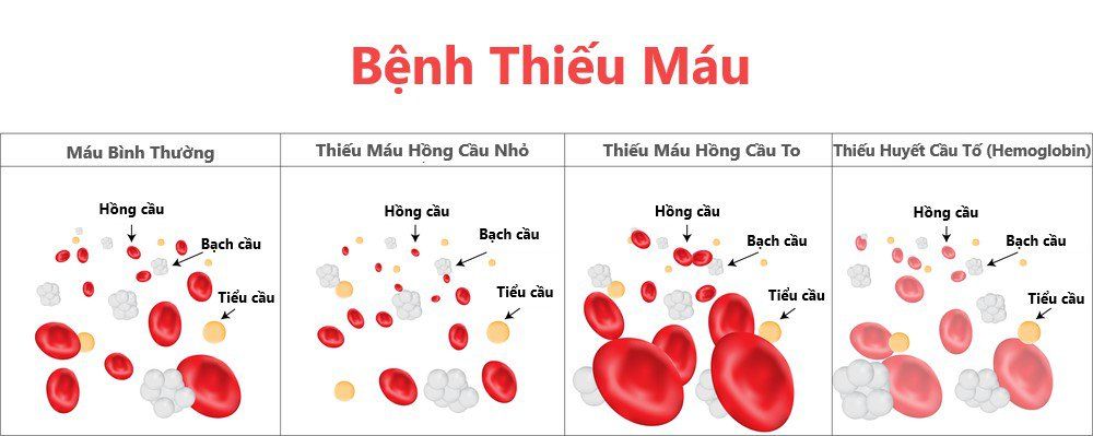 Thiếu máu hồng cầu nhỏ: Nguyên nhân, triệu chứng và cách điều trị hiệu quả