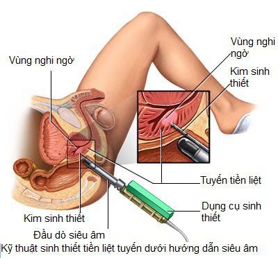 
Kết quả sinh thiết cho phép nguyên nhân và phương pháp điều trị viêm tuyến tiền liệt
