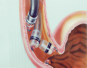 Is there a need for frequent esophageal varices?