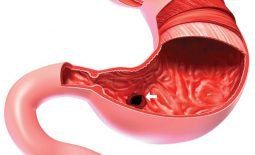 Is Kimura C1 atrophic gastritis dangerous?