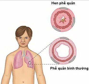 
Thuốc pulmicort respules có tác dụng điều trị hen phế quản
