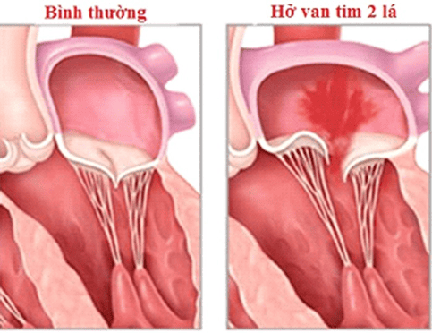 Đang mang thai nhưng bị hở van tim, cơ thể mệt mỏi có ảnh hưởng gì không?