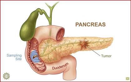 Endocrine pancreatic tumor is diagnosed by any medical technique?