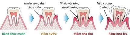 
Mất răng do viêm quanh răng
