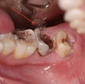 
Răng khôn mọc lệch ra má gây sâu răng khôn và các răng kế cận
