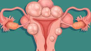 U xơ tử cung có ảnh hưởng đến sinh sản không và điều trị thế nào?