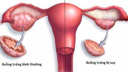 Chỉ số AMH thấp, FSH cao có khả năng mang thai được không?