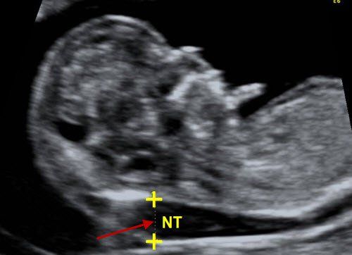 The nuchal translucency measured at more than 12 weeks gestation is 1.2mm, is it okay?