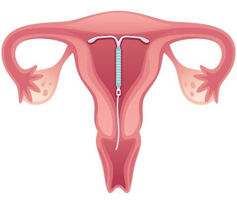 
Kyleena Intrauterine được đặt vào tử cung của phụ nữ
