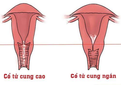 Bà bầu có cổ tử cung ngắn thì phải làm sao?