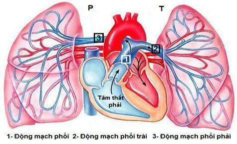 Tìm hiểu về bệnh lý tăng áp phổi