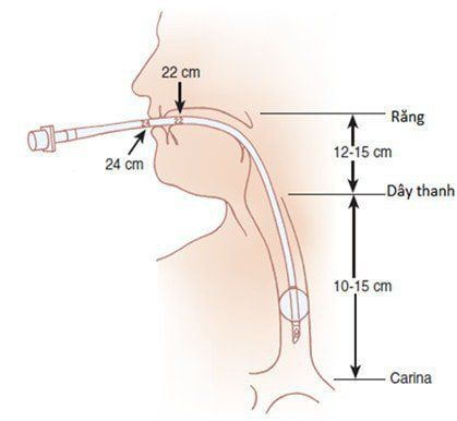 
Đặt nội khí quản nếu người bệnh suy hô hấp hôn mê
