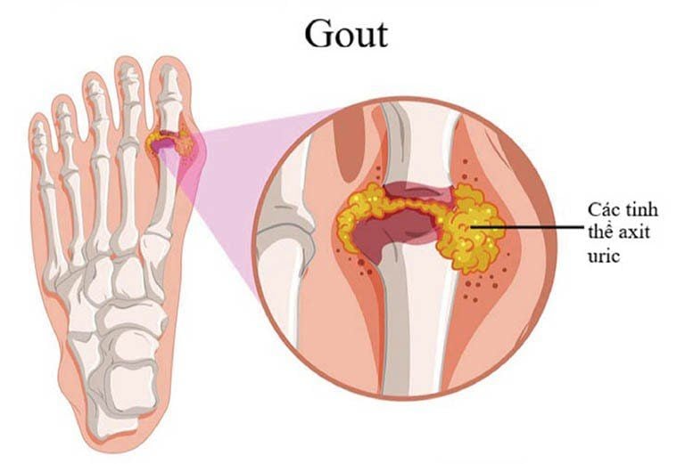 What you need to know about Gout | Vinmec