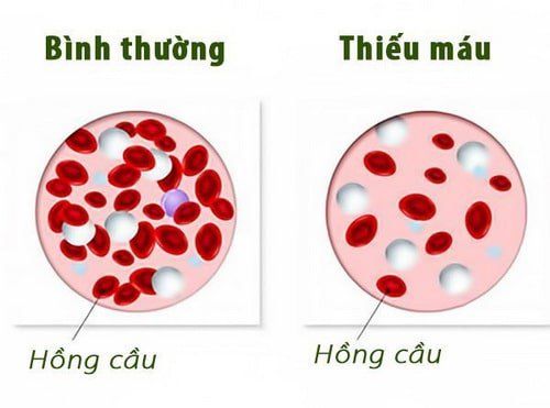 
Thiếu máu là tình trạng cơ thể không có đủ lượng hồng cầu hoặc huyết sắc tố
