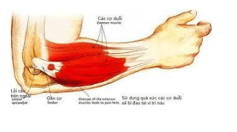 Phục hồi chức năng viêm lồi cầu ngoài xương cánh tay