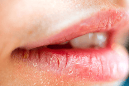 7 dermatologist tips to heal dry chapped lips