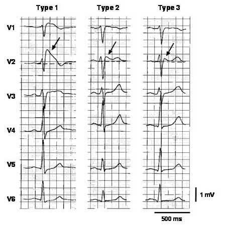 Frequently asked questions about Brugada's Syndrome