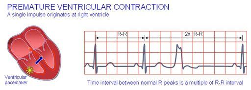 What is ventricular extrasystoles?