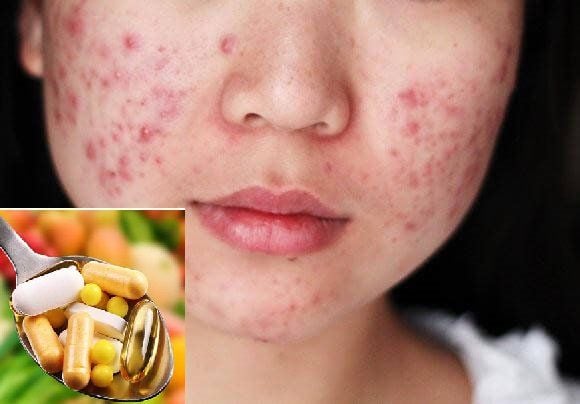 The best minerals and vitamins for acne-prone skin | Vinmec