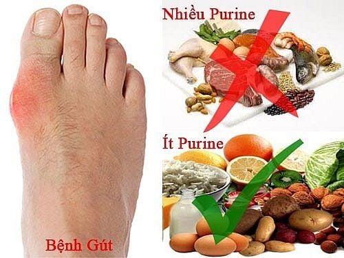 
Bệnh gút: Cần hạn chế ăn các thực phẩm có nhiều nhân purin
