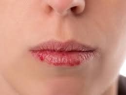 Active cheilitis: Symptoms, treatment, prevention