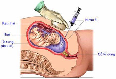 
Chọc ối có thể cần thiết nếu bạn đang chuyển dạ sinh non
