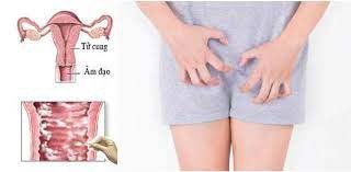 Ra huyết trắng gây ngứa gây viêm âm đạo không?