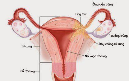 Tăng sản niêm mạc cổ ngoài nghĩa là gì?