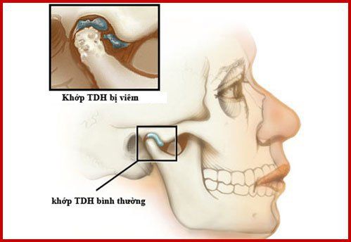 
Viêm khớp thái dương hàm ơt giai đoạn đầu có thể được điều trị tại nhà
