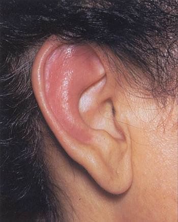 Cách xử lý viêm sụn nhẹ do xỏ lỗ tai tại nhà là gì?