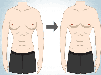 Nguyên nhân gây ngực to ở nam giới là gì?