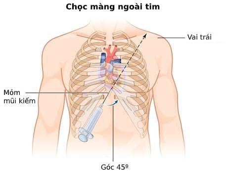 
Ép tim cấp do tràn dịch màng ngoài tim
