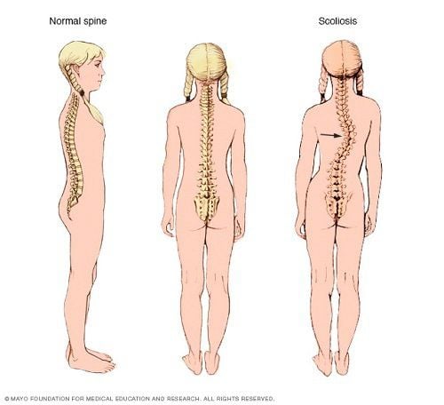 
Chứng vẹo cột sống là một dấu hiệu tổn thương tim do hội chứng Marfan
