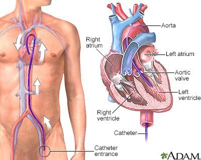 
Trong hội chứng ALCAPA, LCA nguồn gốc bắt đầu từ động mạch phổi.
