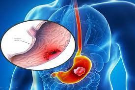 Stomach cancer: Risk factors for the disease