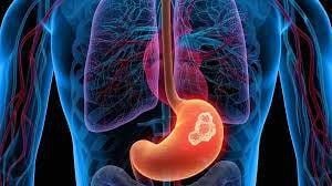 A global perspective on stomach cancer