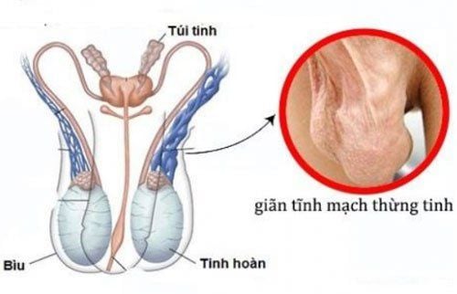 Tinh hoàn chảy xệ kèm căng tức sau mổ giãn tĩnh mạch thừng tinh có sao không?