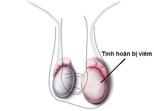 
Hình ảnh mô phỏng tình trạng viêm tinh hoàn
