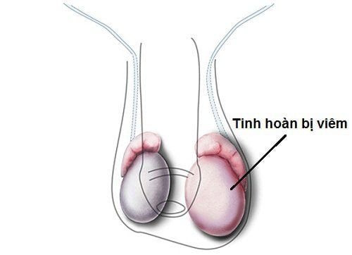 
Hình ảnh mô phỏng tình trạng viêm tinh hoàn
