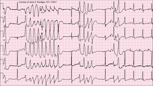 What is torsades de pointes syndrome?