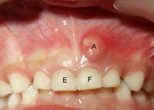 
Các trường hợp viêm túi lợi do phẫu thuật quanh răng, áp xe quanh răng, cần giảm viêm ở túi lợi không quá sâu có thể áp dụng phương pháp nạo túi lợi
