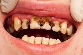 Vì sao ăn kẹo hay bị sâu răng?