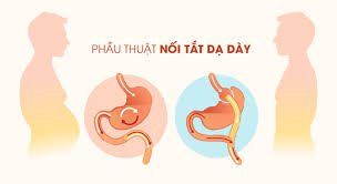 
Phẫu thuật nối tắt dạ dày có thể làm thay đổi hệ vi sinh vật đường ruột
