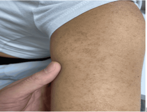 Keratosis pilaris: A disease as rough as goose bumps