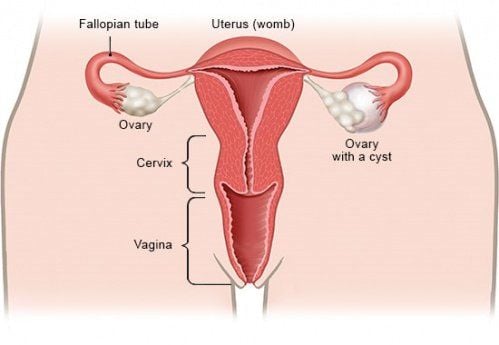 Ovarian mucinous cysts are common?