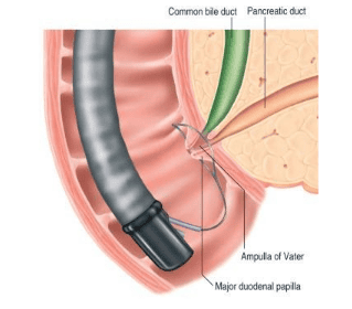 
Thủ thuật cắt polyp ở bóng Vater
