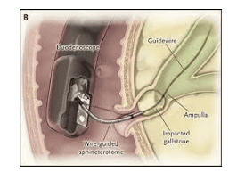 
Can thiệp ERCP lấy sỏi gây viêm tụy cấp
